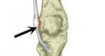 Iliotibial Band Syndrome (Runners Knee) - Sportsinjuryclinic.net
