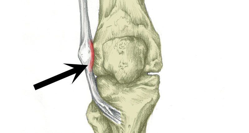 Running into problems: iliotibial band friction syndrome
