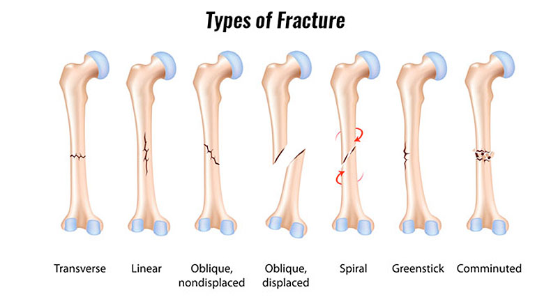 Bone Fractures: Types, Symptoms & Treatment