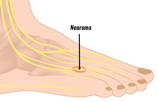 Причины болят пальцы на ногах почему. Синдром Мортона неврома. Неврома метатарзалгия. Неврома Мортона большого пальца стопы.