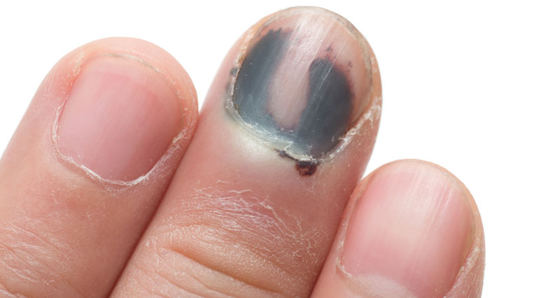Black Fingernail Symptoms Causes Treatment