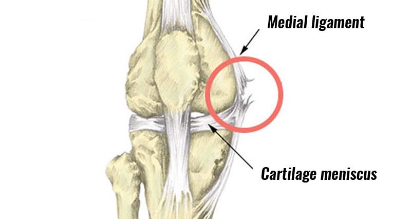 Medial Collateral Ligament injury - Knee Ligament sprain: Knee Physio