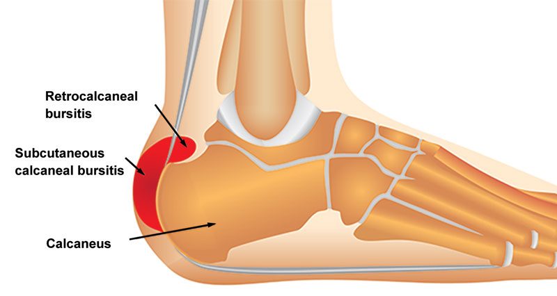Metatarsalgia or Forefoot Pain in Runners