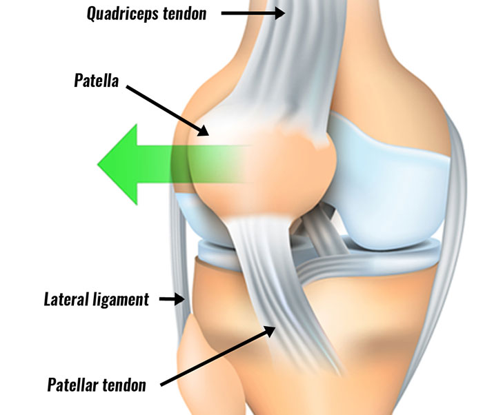subluxation knee