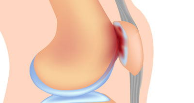 Medial Knee Pain (Inside) - Symptoms, Causes, Treatment & Rehab