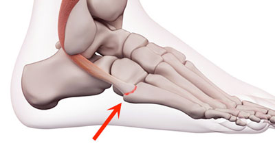 pain around outside of heel