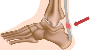 pain at bottom of achilles