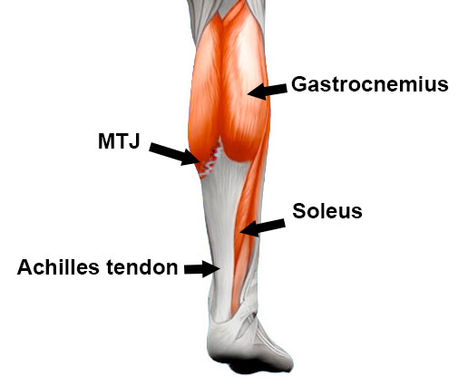 pulled calf muscle