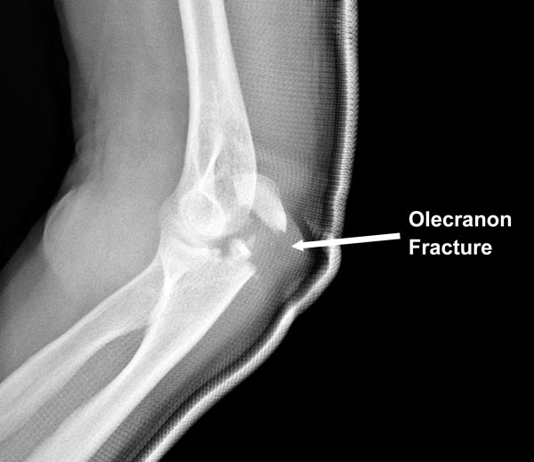 olecranon avulsion fracture